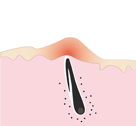 What is an ingrown hair ?