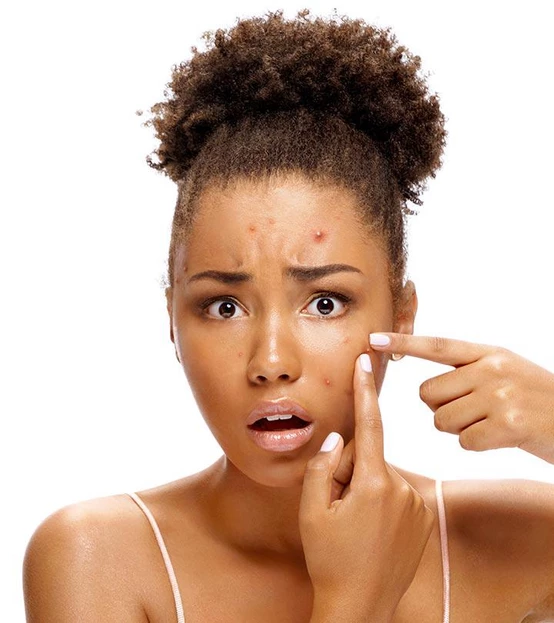 How to get rid of acne !